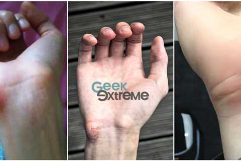 Understanding and Managing Gamer Callus: Causes, Symptoms, and Treatment Options